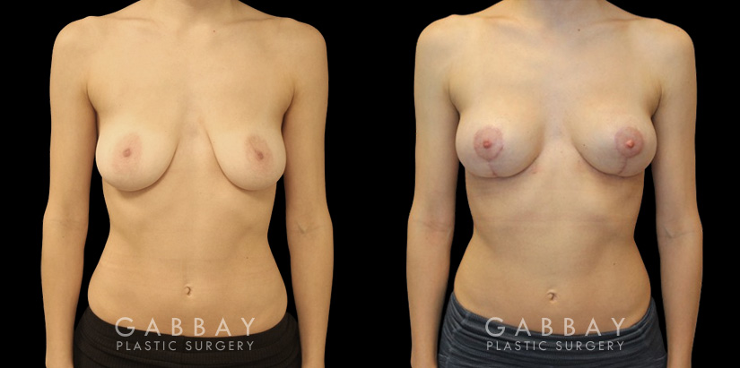 Patient 29 Front View Breast Mastopexy Gabbay Plastic Surgery