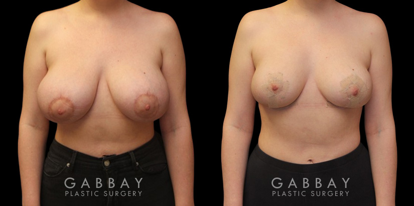 Patient 30 Front View Breast Mastopexy Gabbay Plastic Surgery