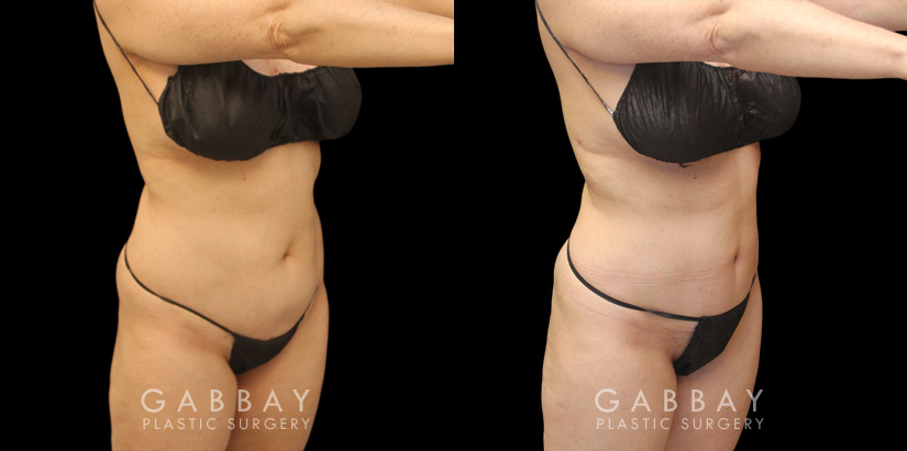 Patient 01 3/4th Right View Mini Tummy Tuck Gabbay Plastic Surgery