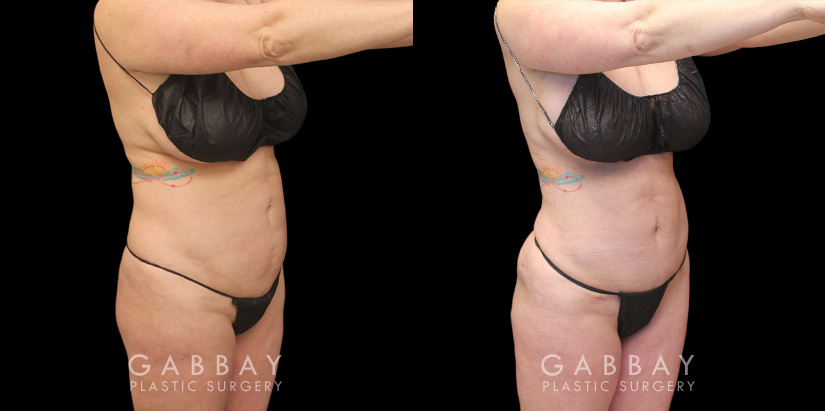 Patient 02 3/4th Right View Mini Tummy Tuck Gabbay Plastic Surgery