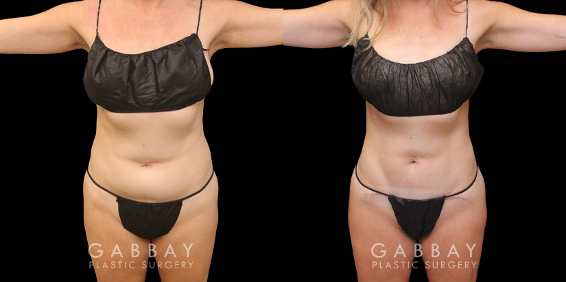 Patient 03 Front View Mini Tummy Tuck Gabbay Plastic Surgery