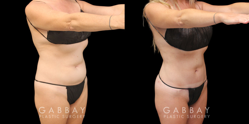 Patient 03 3/4th Right View Mini Tummy Tuck Gabbay Plastic Surgery