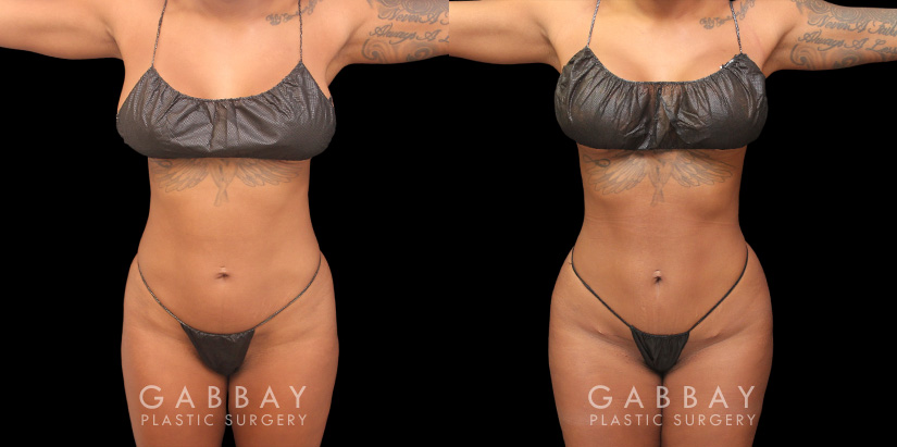 Patient 04 Front View Mini Tummy Tuck Gabbay Plastic Surgery