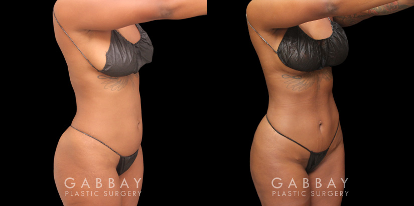 Patient 04 3/4th Right View Mini Tummy Tuck Gabbay Plastic Surgery