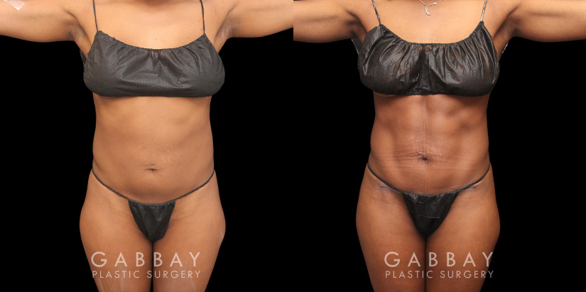 Patient 05 Front View Mini Tummy Tuck Gabbay Plastic Surgery