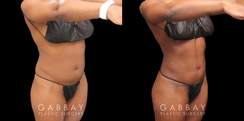 Patient 05 3/4th Right View Mini Tummy Tuck Gabbay Plastic Surgery