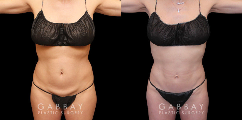 Patient 06 Front View Mini Tummy Tuck Gabbay Plastic Surgery