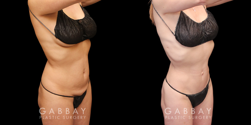 Patient 06 3/4th Right View Mini Tummy Tuck Gabbay Plastic Surgery