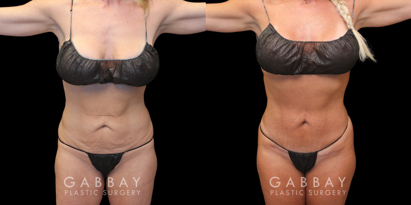 Patient 07 Front View Mini Tummy Tuck Gabbay Plastic Surgery