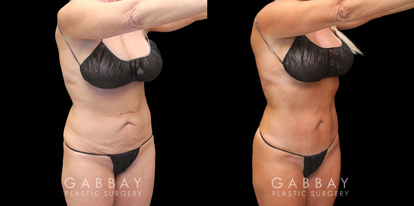 Mini Tummy Tuck Before and After