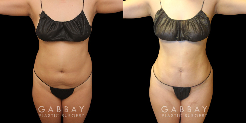 Patient 08 Front View Mini Tummy Tuck Gabbay Plastic Surgery