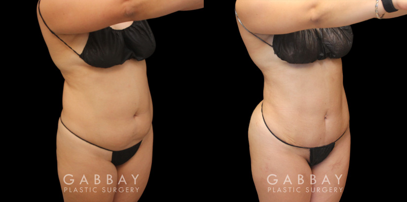 Patient 08 3/4th Right View Mini Tummy Tuck Gabbay Plastic Surgery