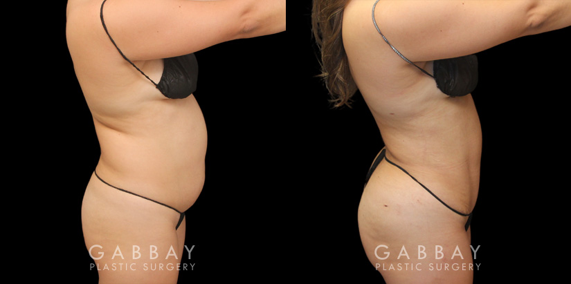 Patient 08 Right View Mini Tummy Tuck Gabbay Plastic Surgery