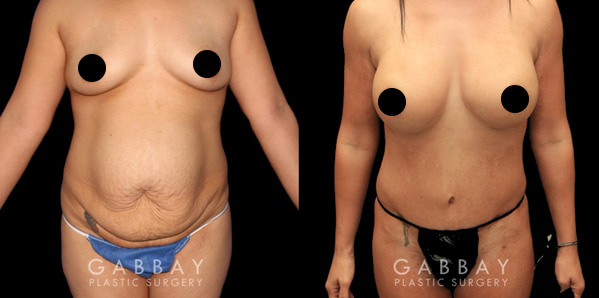 Mommy Makeover Los Angeles by Dr. Gabbay. Before and After Photo