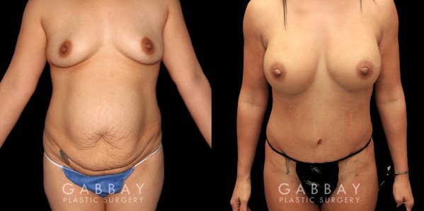 Mommy Makeover Los Angeles by Dr. Gabbay. Before and After Photo