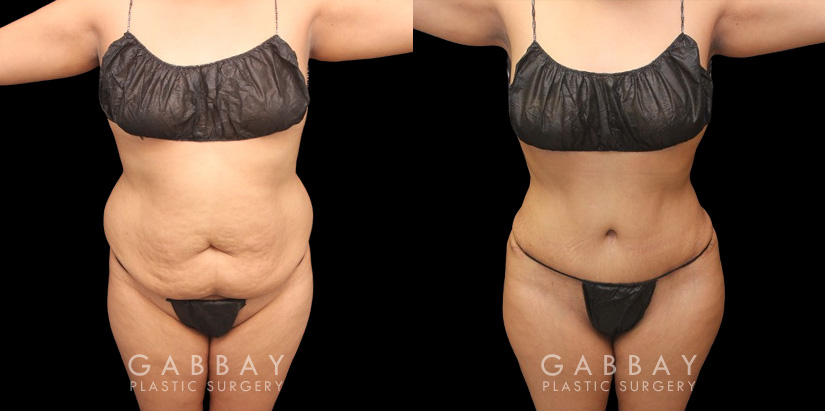 Female patient before-and-after photos for mommy makeover involving 360 liposuction. Note the restored curves around the waist and the flattened abdominal profile with no visible scarring. Patient regained a smooth abdominal area with no evidence of the stretching from pregnancy.