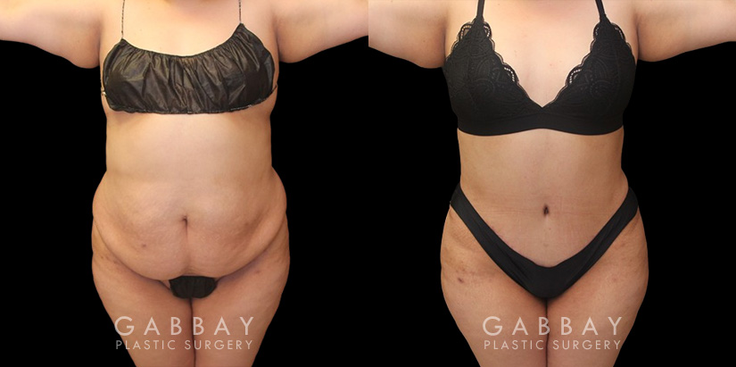 Mommy makeover before-and-after photos depicting results of combined 360 liposuction and tummy tuck. Note particularly how flank liposuction and tightening resulting in restoring a curvier silhouette and a natural-looking figure. Both the abdomen and flanks were tightened and smoothed for a youthful contour from every angle.