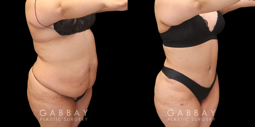 Patient 06 3/4th Right View Mommy Makeover Gabbay Plastic Surgery