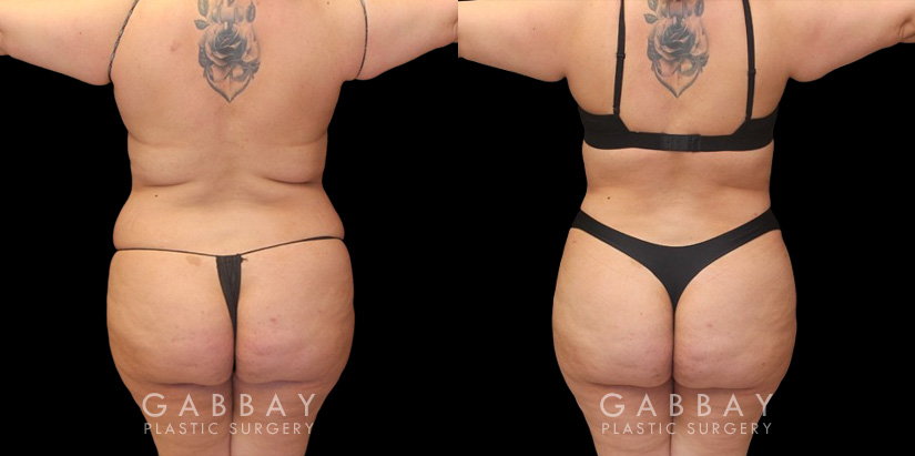 Patient 06 Back View Mommy Makeover Gabbay Plastic Surgery
