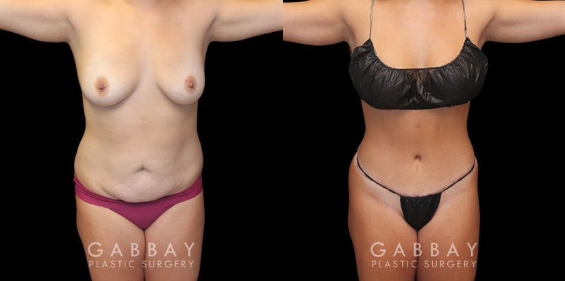 Mommy makeover patient results before and after the procedure. Before the mommy makeover, the patient had loose, excess skin and stubborn pockets of fat. After the 360 liposuction and tummy tuck, the patient’s flanks and abdomen show a flatter, smoother contour.