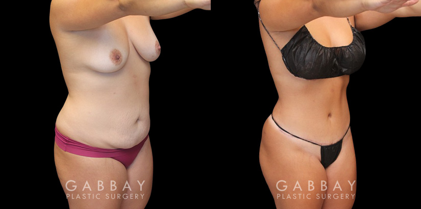 Mommy makeover patient results before and after the procedure. Before the mommy makeover, the patient had loose, excess skin and stubborn pockets of fat. After the 360 liposuction and tummy tuck, the patient’s flanks and abdomen show a flatter, smoother contour.