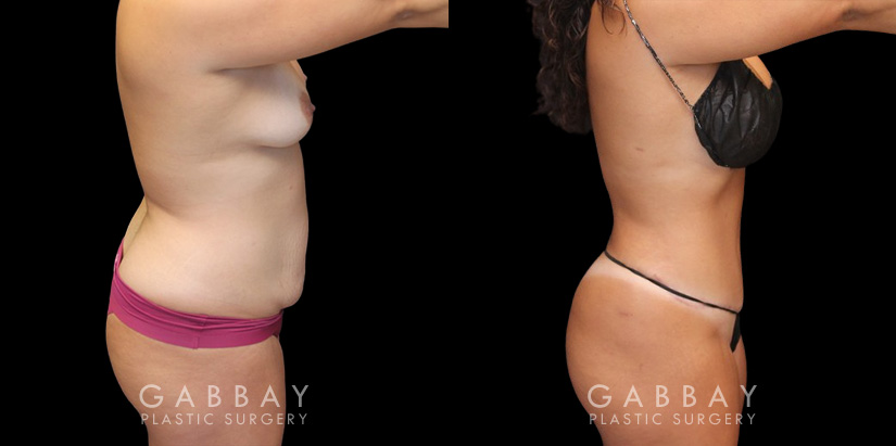 Mommy makeover patient results before and after the procedure. Before the mommy makeover, the patient had loose, excess skin and stubborn pockets of fat. After the 360 liposuction and tummy tuck, the patient’s flanks and abdomen show a flatter, smoother contour.