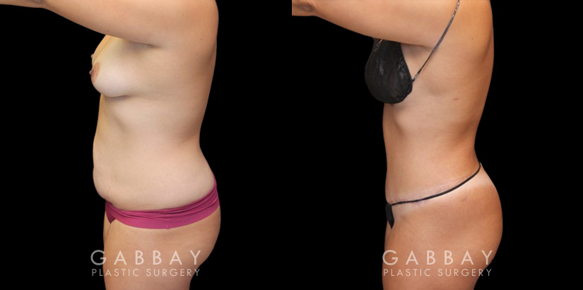 Mommy makeover patient results before and after the procedure. Before the mommy makeover, the patient had loose, excess skin and stubborn pockets of fat. After the 360 liposuction and tummy tuck, the patient’s flanks and abdomen show a flatter, smoother contour.