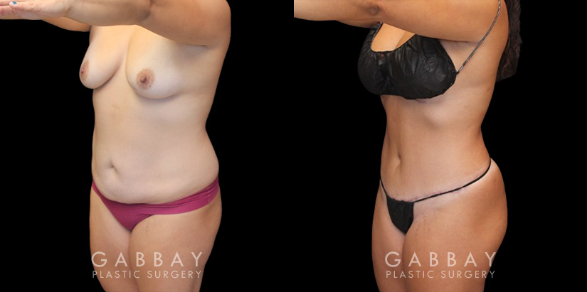 Mommy makeover patient results before and after the procedure. Before the mommy makeover, the patient had loose, excess skin and stubborn pockets of fat. After the 360 liposuction and tummy tuck, the patient’s flanks and abdomen show a flatter, smoother contour.