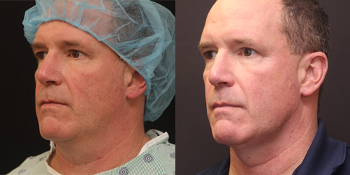 before after image chin and neck liposuction procedure patient 7