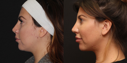 before after image chin and neck liposuction procedure patient 1