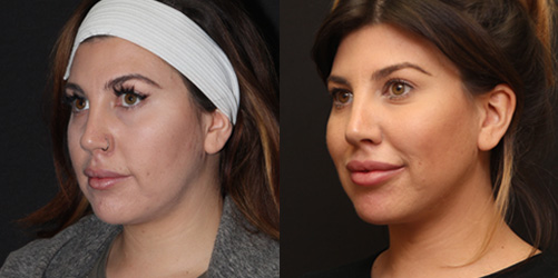 before after image chin and neck liposuction procedure patient 2