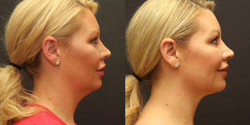 before after image chin and neck liposuction procedure patient 3