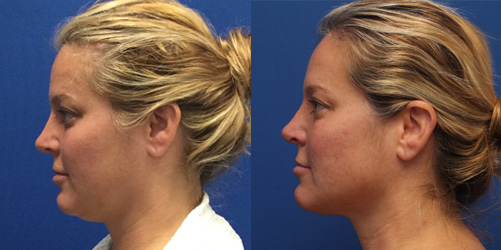 before after image chin and neck liposuction procedure patient 4
