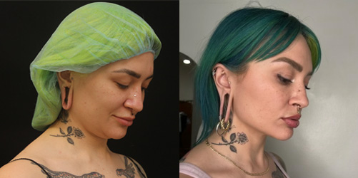 before after image chin and neck liposuction procedure patient 5
