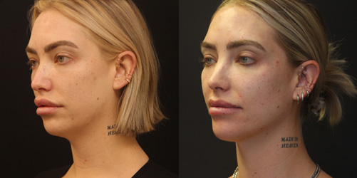 before after image chin and neck liposuction procedure patient 6