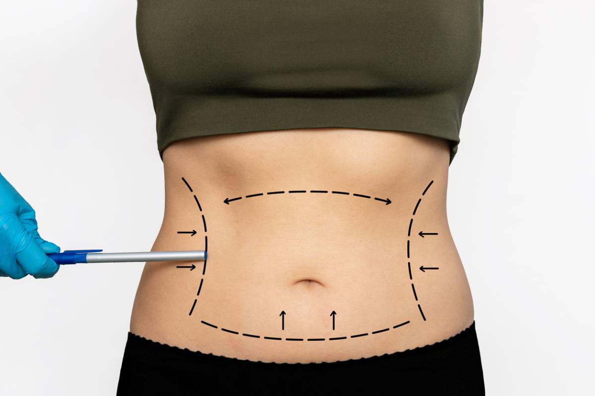 featured image for surprising benefits of liposuction