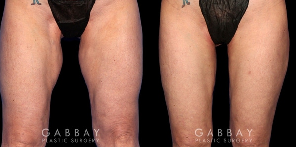 Thigh Lift Before and After Patient 01 Front View Gabbay Plastic Surgery