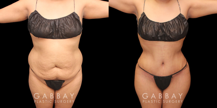 Patient showcasing results of abdominal tightening and liposuction to the abdomen, waist, and flanks. Photos show a restoration of the patient’s natural figure with curves and shape.