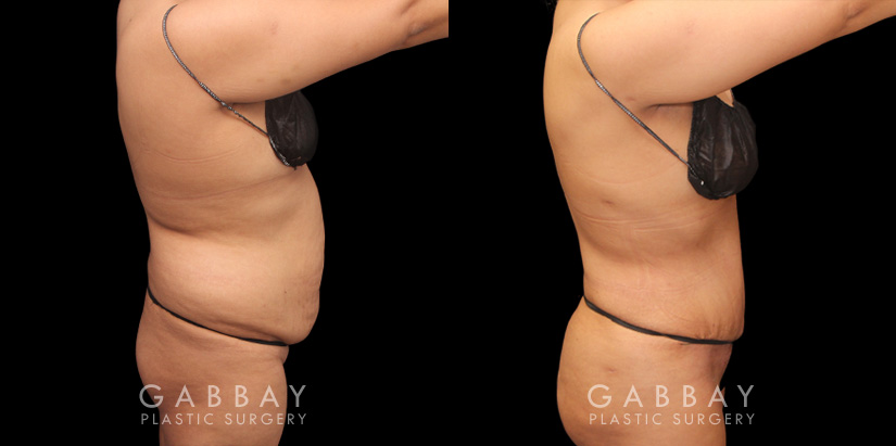 Patient showcasing results of abdominal tightening and liposuction to the abdomen, waist, and flanks. Photos show a restoration of the patient’s natural figure with curves and shape.