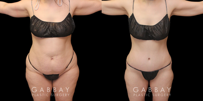 Note the loose skin tightened over the lower abdomen, with no hanging pockets of fat following the patient’s tummy tuck procedure. Before and after photos demonstrate the restoration of a youthful physique and smoother, firm-looking skin around the stomach.