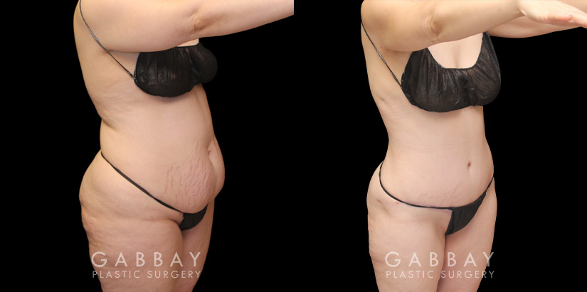 Note the loose skin tightened over the lower abdomen, with no hanging pockets of fat following the patient’s tummy tuck procedure. Before and after photos demonstrate the restoration of a youthful physique and smoother, firm-looking skin around the stomach.