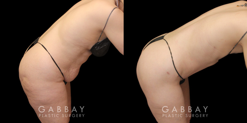 Note the loose skin tightened over the lower abdomen, with no hanging pockets of fat following the patient’s tummy tuck procedure. Before and after photos demonstrate the restoration of a youthful physique and smoother, firm-looking skin around the stomach.