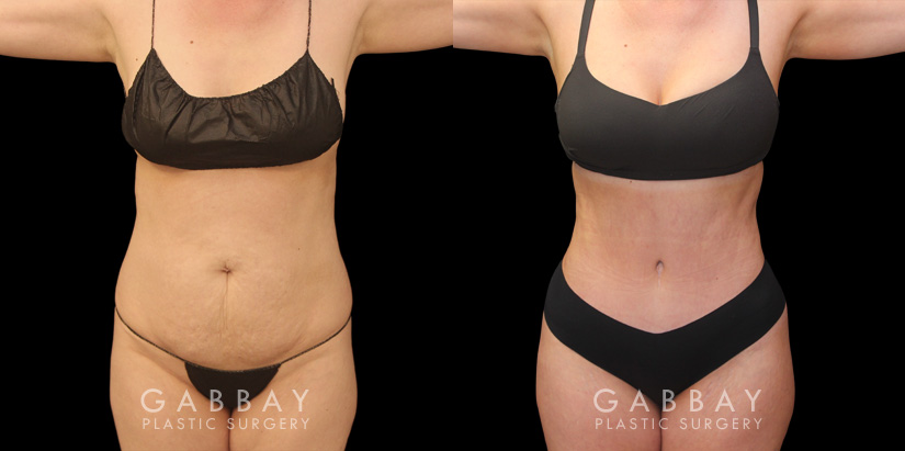 Patient photos of results from tummy tuck procedure at Gabbay Plastic Surgery. Patient recovered well, and results show a firmer, tighter abdominal area with notable improvements in silhouette and side angle views.