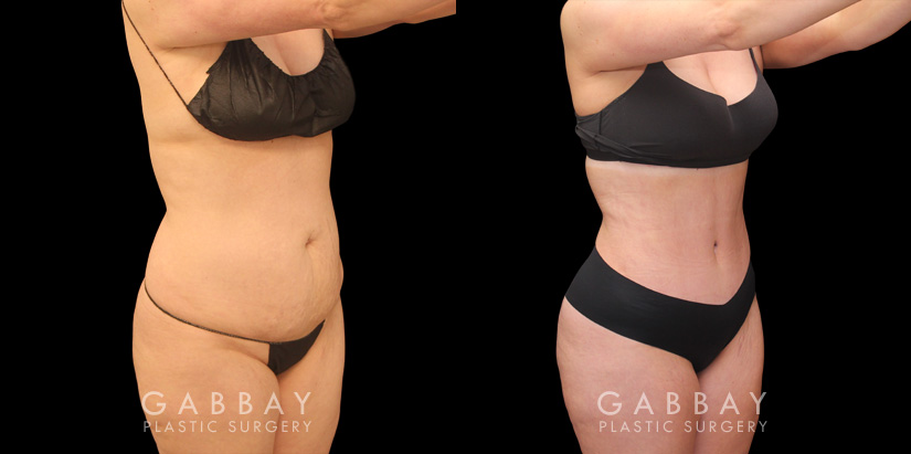 Patient photos of results from tummy tuck procedure at Gabbay Plastic Surgery. Patient recovered well, and results show a firmer, tighter abdominal area with notable improvements in silhouette and side angle views.