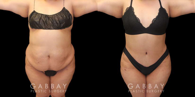 Tummy tuck patient photos from before and after the procedure. On the left, patient shows loose skin and significant banding/rolling of the skin. After the surgery, patient has tightened skin on all angles and note the absence of overhanging skin even when leaning forward.