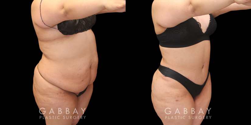Tummy tuck patient photos from before and after the procedure. On the left, patient shows loose skin and significant banding/rolling of the skin. After the surgery, patient has tightened skin on all angles and note the absence of overhanging skin even when leaning forward.