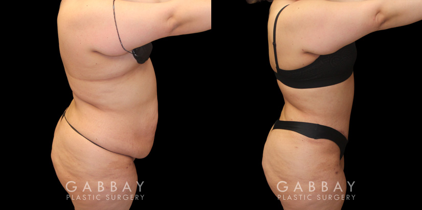 Tummy Tuck Before and After Photo Gallery, Page 3 of 4