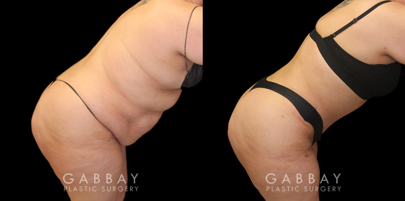 Tummy tuck patient photos from before and after the procedure. On the left, patient shows loose skin and significant banding/rolling of the skin. After the surgery, patient has tightened skin on all angles and note the absence of overhanging skin even when leaning forward.