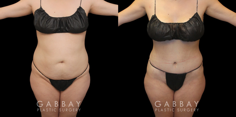 Mild tummy tuck results photos showing the patient’s smoother abdomen, absence of visible scarring, and natural appearance to results. Rather than look like a surgery, the slimming effect blends with her natural features.