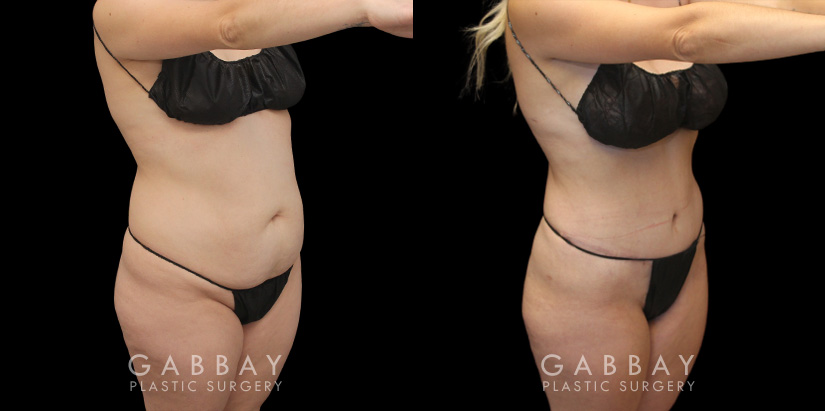 Mild tummy tuck results photos showing the patient’s smoother abdomen, absence of visible scarring, and natural appearance to results. Rather than look like a surgery, the slimming effect blends with her natural features.